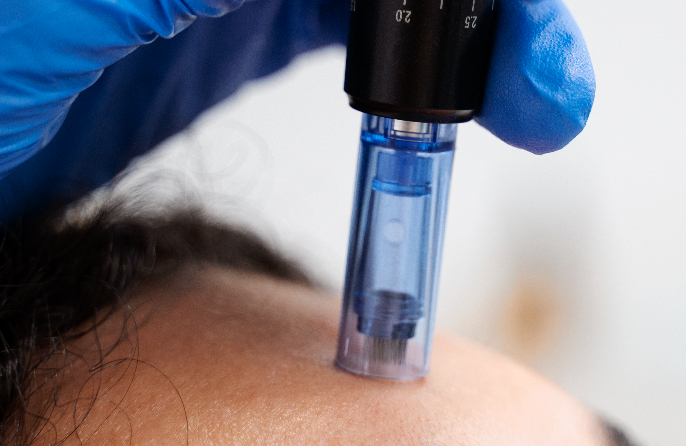 Des micro-injections, une peau revitalisée